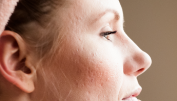 Acne Management