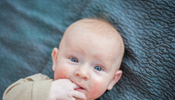 Atopic Dermatitis