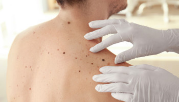 SCARD Skin Cancer Surgical Audit